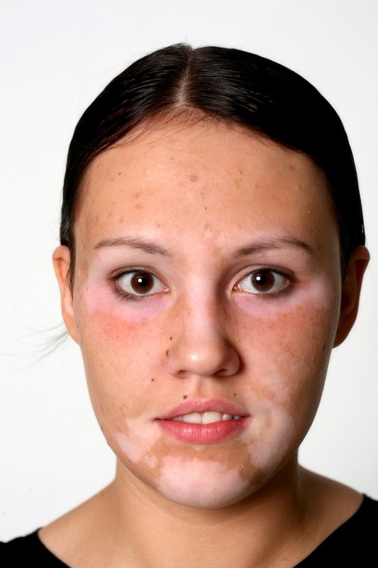 Vitiligo Tedavisi Olmayan Bir Cilt Hastalığı Mı